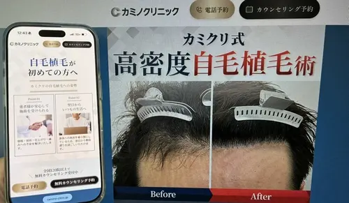 カミノクリニックの自毛植毛
